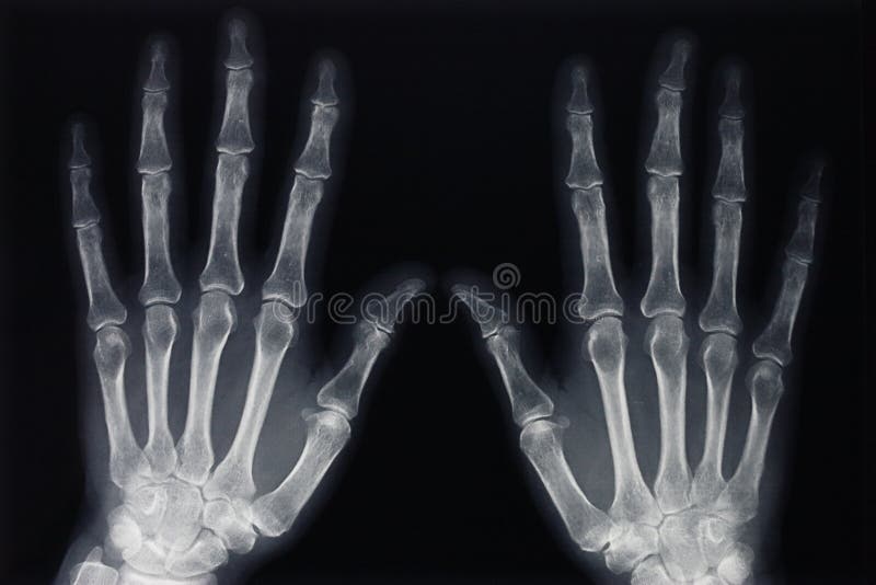 X-ray of two hands. Medical background. X-ray of two hands. Medical background