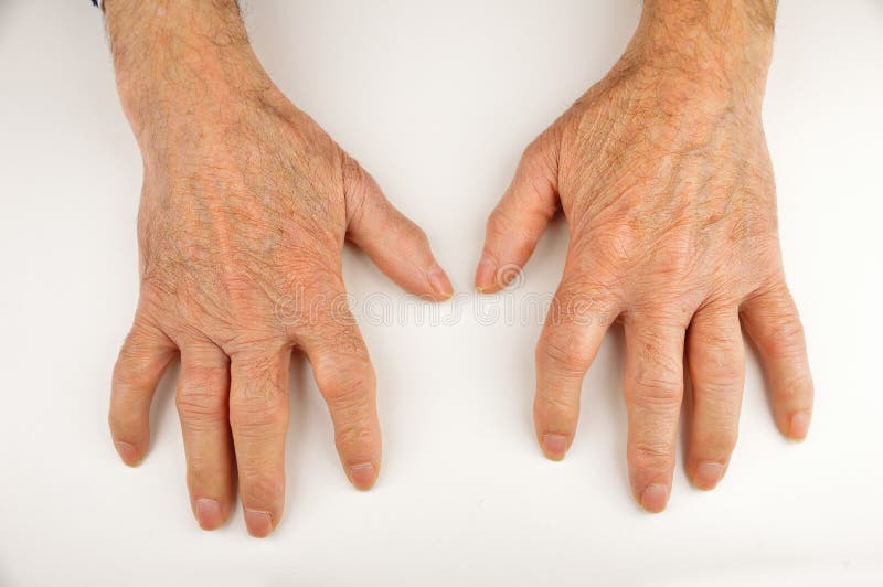 Elderly Hands With Rheumatoid Arthritis Stock Image Image of ugly, isolated 17210339
