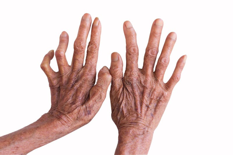 Hands Of A Leprosy Isolated On White Background Stock Photo Image