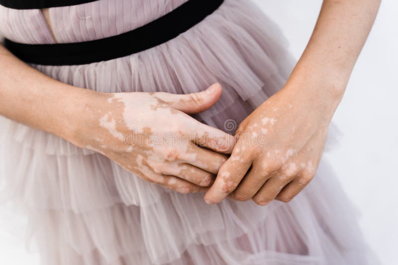 Hands With Vitiligo Skin Pigmentation Lifestyle With Seasonal Skin