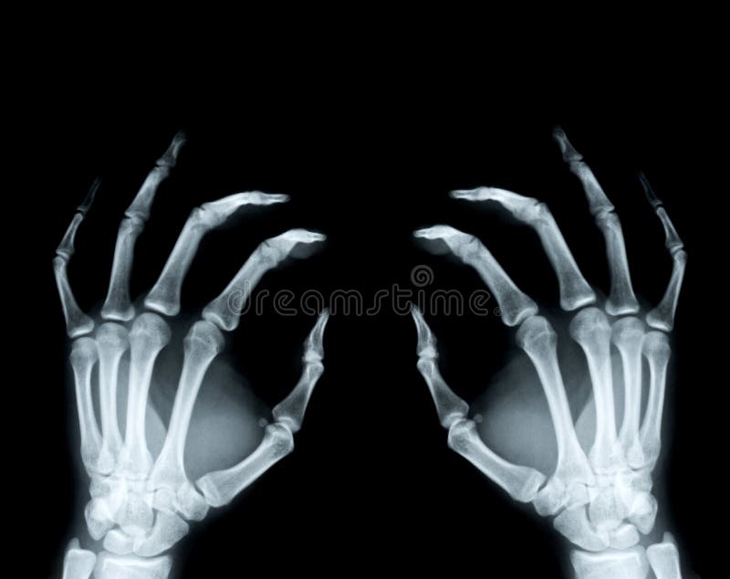 Hands X-ray