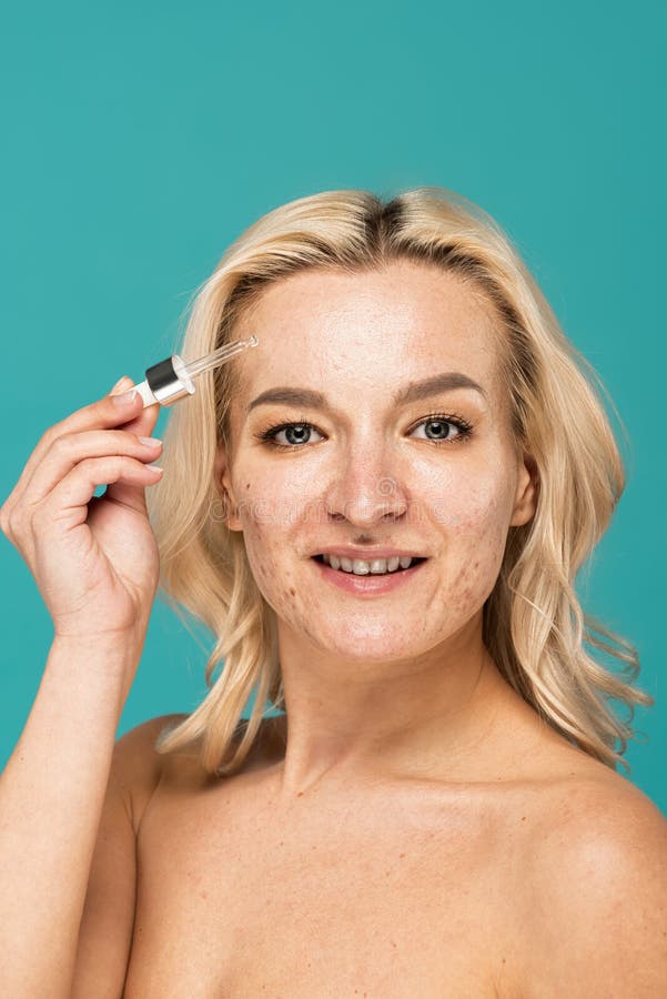Happy Woman with Acne on Face Stock Image Image of blue, happy 273670593