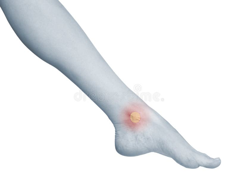 Healing Blister on the Foot Ankle. Stock Image Image of plaster