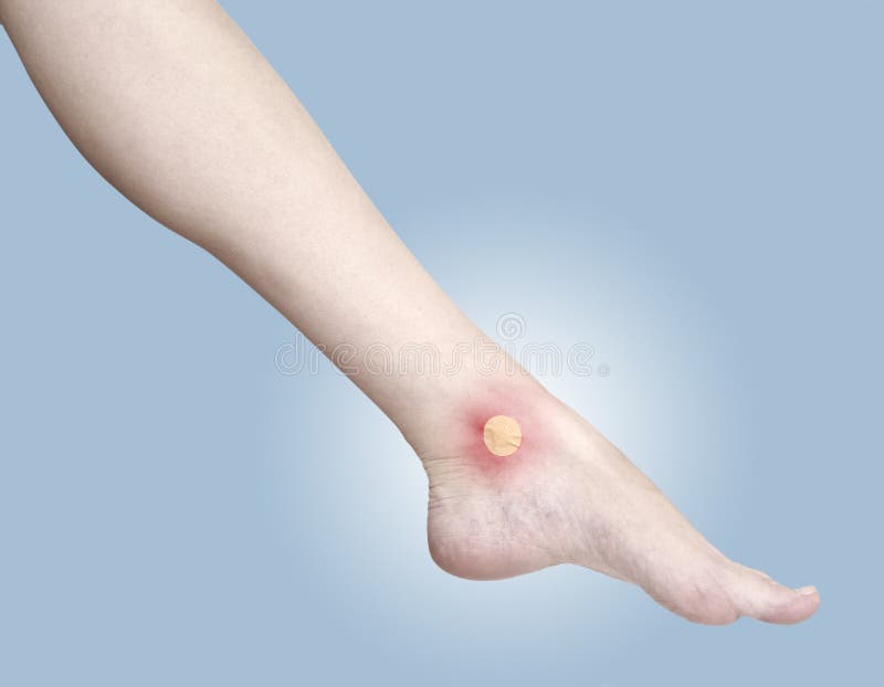 Healing Blister on the Foot Ankle. Stock Photo Image of court, ache