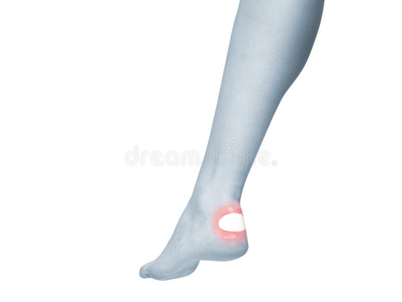 Healing Blister on the Foot Ankle. Stock Photo Image of court, ache