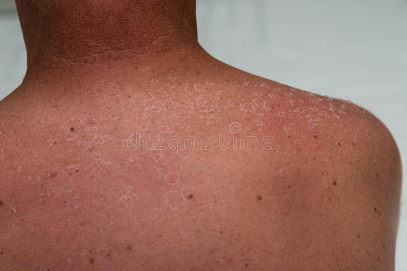 Rash Sun Allergy Photos Free Royalty Free Stock Photos From Dreamstime