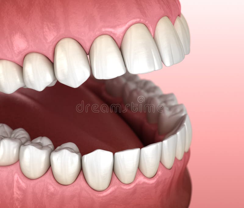 Normal Occlusion Tooth 3d Stock Illustrations – 10 Normal Occlusion