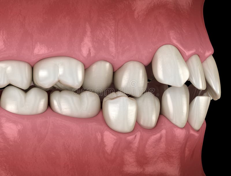 Healthy Human Teeth with Normal Occlusion, Side View. Medically