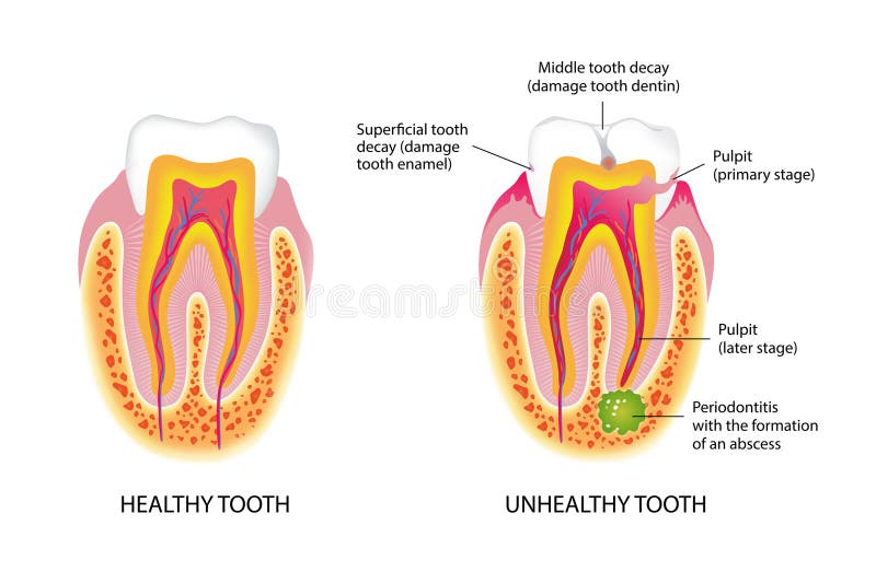 Healthy And Unhealthy Tooth Stock Illustration Illustration Of