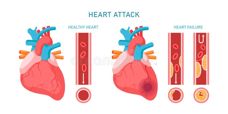 Heart attack and cardiovascular diseases infographic. Healhty and failure hearts, atherosclerosis symptoms and diagnosis.