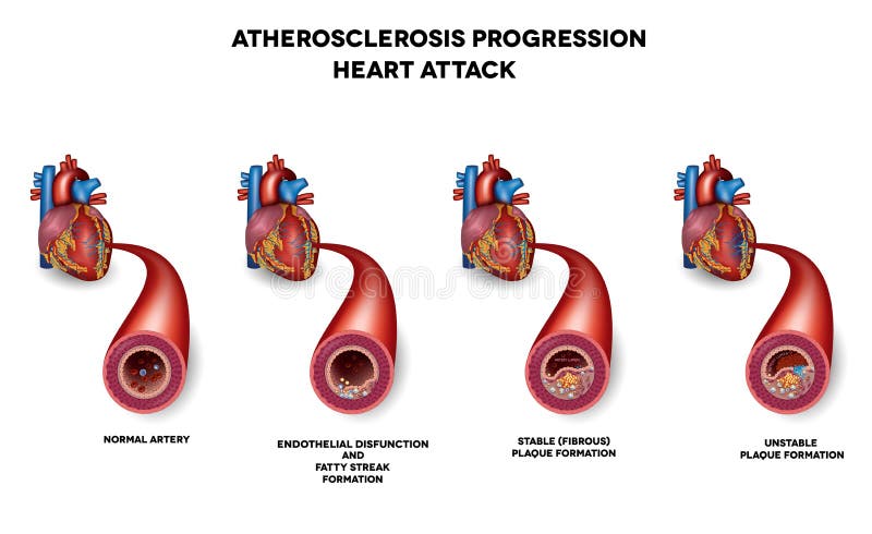 Heart attack, Coronary artery disease