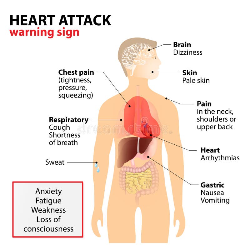 Heart attack symptoms stock photo. Image of cardiac 