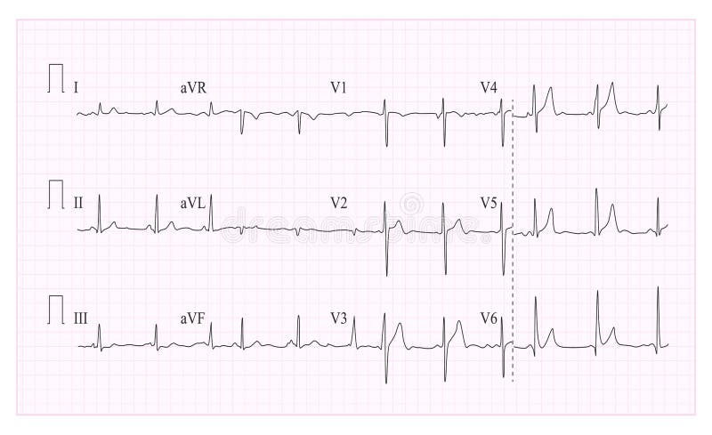 Heart Cardiogram Chart Vector. Illustration Of Wave Form On Checked Ecg Graph. Heart Rhythm, Ischemia, Infarction. Vitality Heartb