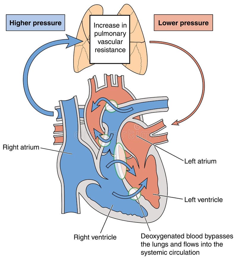 Heart defects causing Eisenmenger syndrome