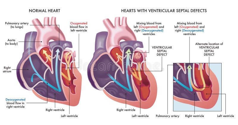 Heart defects