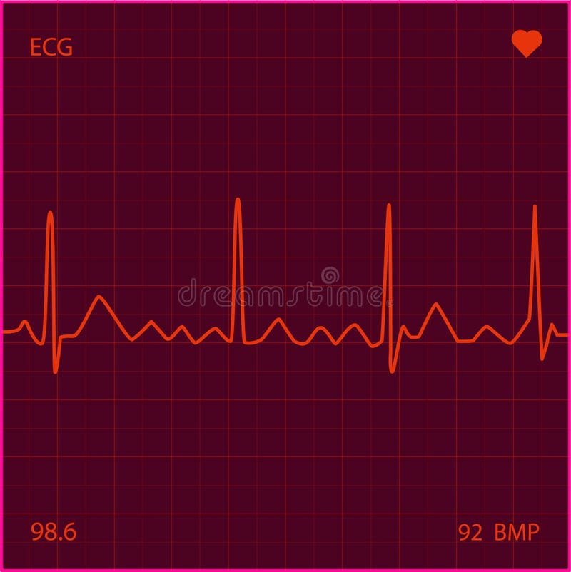 Ventricular Tachycardia Deadly Heart Arrhythmia Stock Illustration