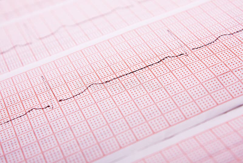 Heart rate on medical print out