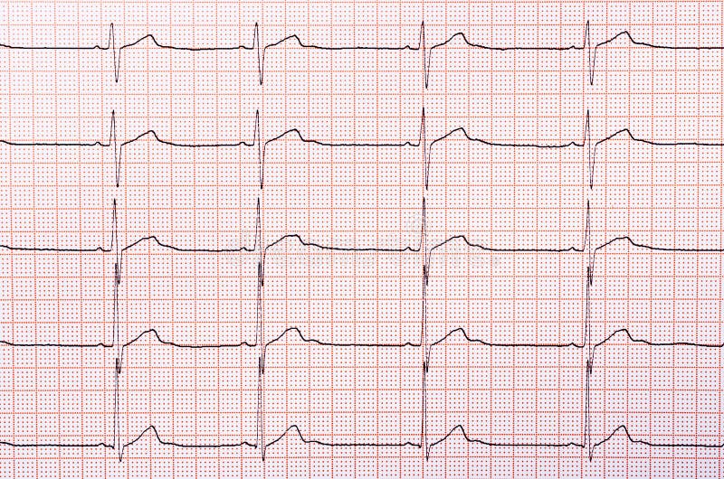 Sinus Rhythm Chart