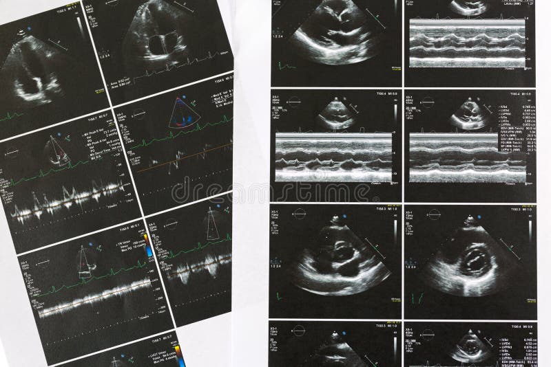 Printed set result paper of heart ultrasound scan examination. Echo cardiography examine for irregular heart beats, abnormal rhythm arrhythmia