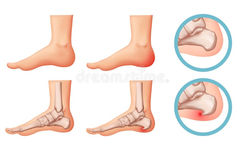 Heel spur illustration. Design elements on the theme of plantar fasciitis. Vector set stock illustration