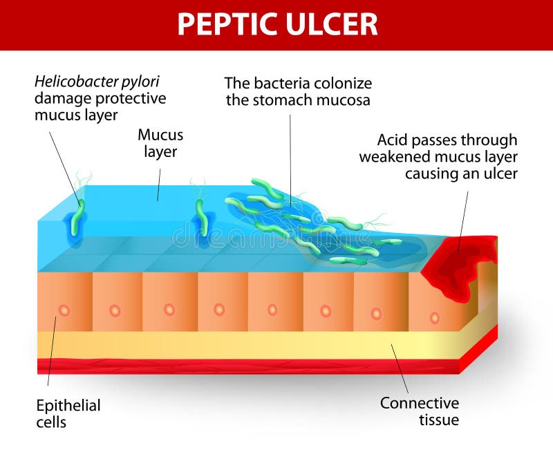 Helicobacter wrzodów i odźwierników choroba ilustracji Helicobacter wrzodów i odźwierników choroba ilustracji