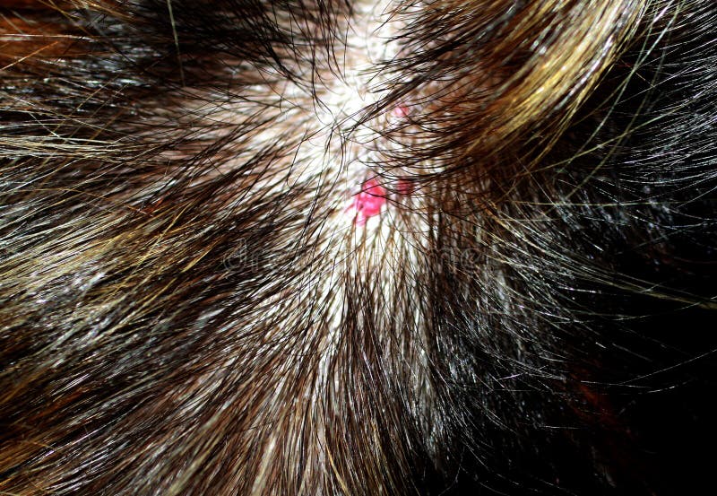 Hemangioma auf dem Kopf Rote Mole auf der Kopfhaut Mole im Haar Feuermal. 