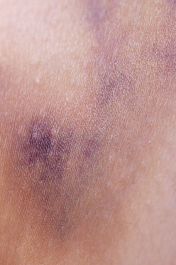 Hematoma on the Skin of the Legs Stock Image Image of stain, blue