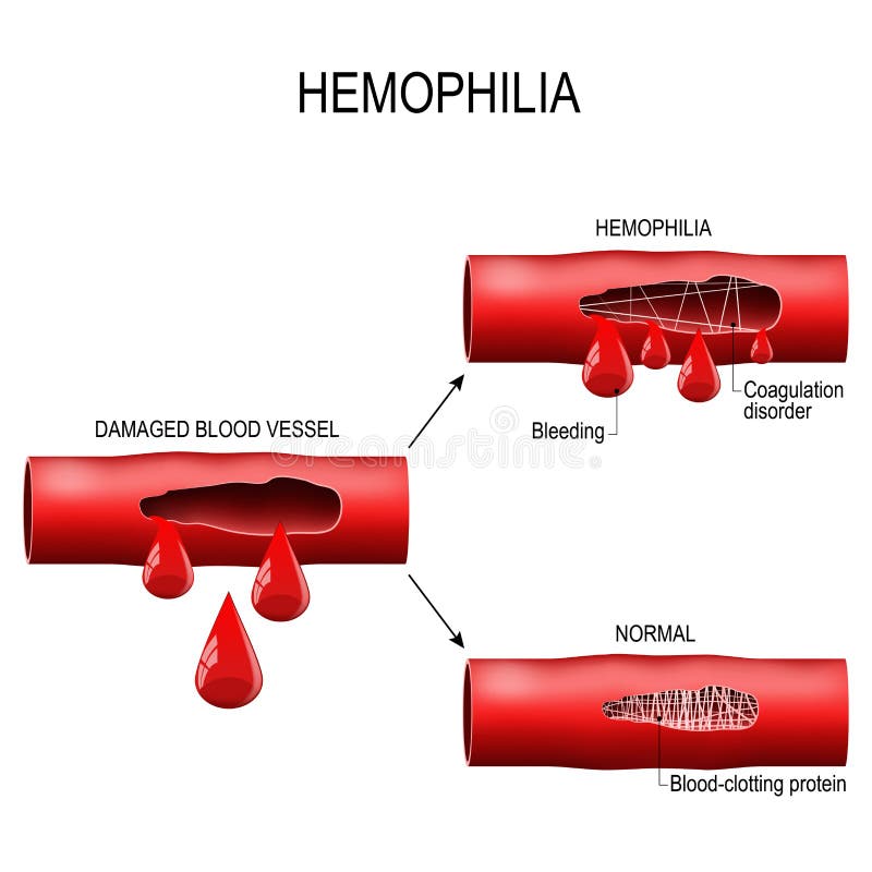 Hemofilia Jest Chorobą Recesywną Sprzężoną Z Płcią Mechanizm Dziedziczenie Hemofilia Infographics Wektorowa Ilustracja Na