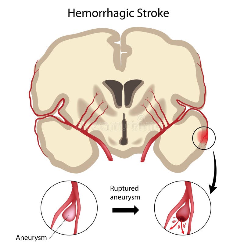 hemorrhagic slaglängd för hjärna vektor illustrationer hemorrhagic slaglängd för hjärna vektor illustrationer