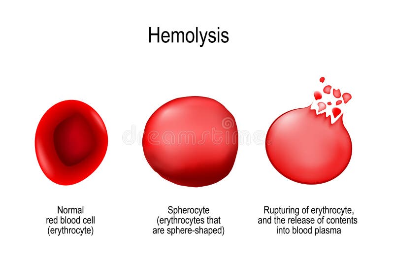 Hemólisis Glóbulo rojo normal, spherocyte, y ruptura de e libre illustration Hemólisis Glóbulo rojo normal, spherocyte, y ruptura de e libre illustration