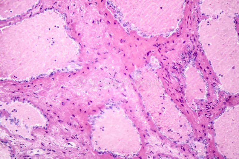 Hepatic cavernous hemangioma royalty free stock photography