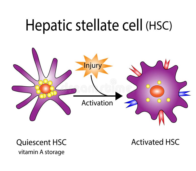 Hepatic stellate cell (HSC), liver fibrosis. vector illustration.