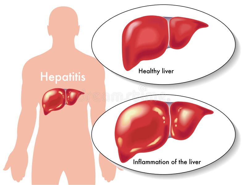 Ilustraciones de síntomas de inflamación del hígado.