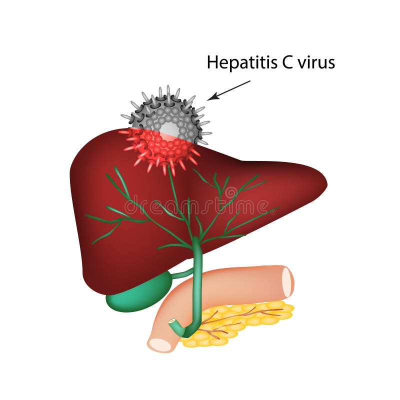 Hepatitis c the introduction of the hepatitis c virus in the liver