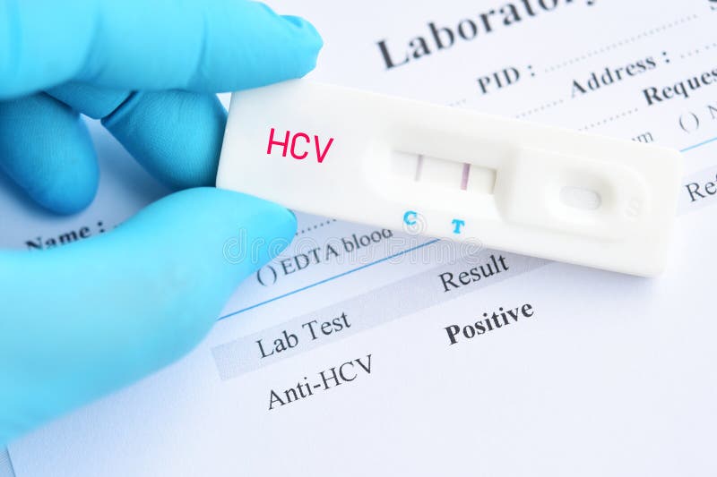 Hepatitis C virus positive test result royalty free stock photo