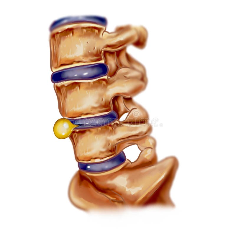 A illustration of hernia