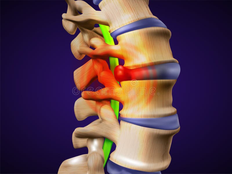 A herniated disc. Also called bulged, slipped or ruptured.