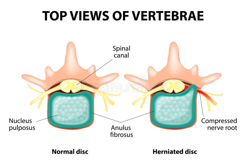Herniated dysk ilustracji Herniated dysk ilustracji