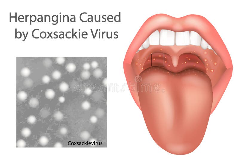 Herpangina Caused by Coxsackievirus. Medical Illustration of Coxsackievirus Infection in Throat and Mouth. stock illustration