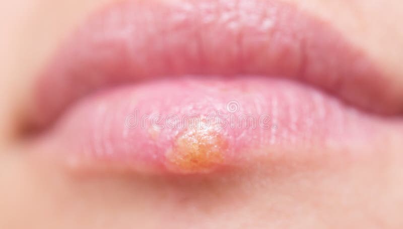 Herpes auf Lippen lizenzfreies stockfoto Herpes auf Lippen lizenzfreies stockfoto