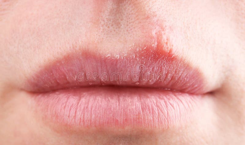 Herpes Blisters  not far off from Female Lips  accretion Photo - Image of  