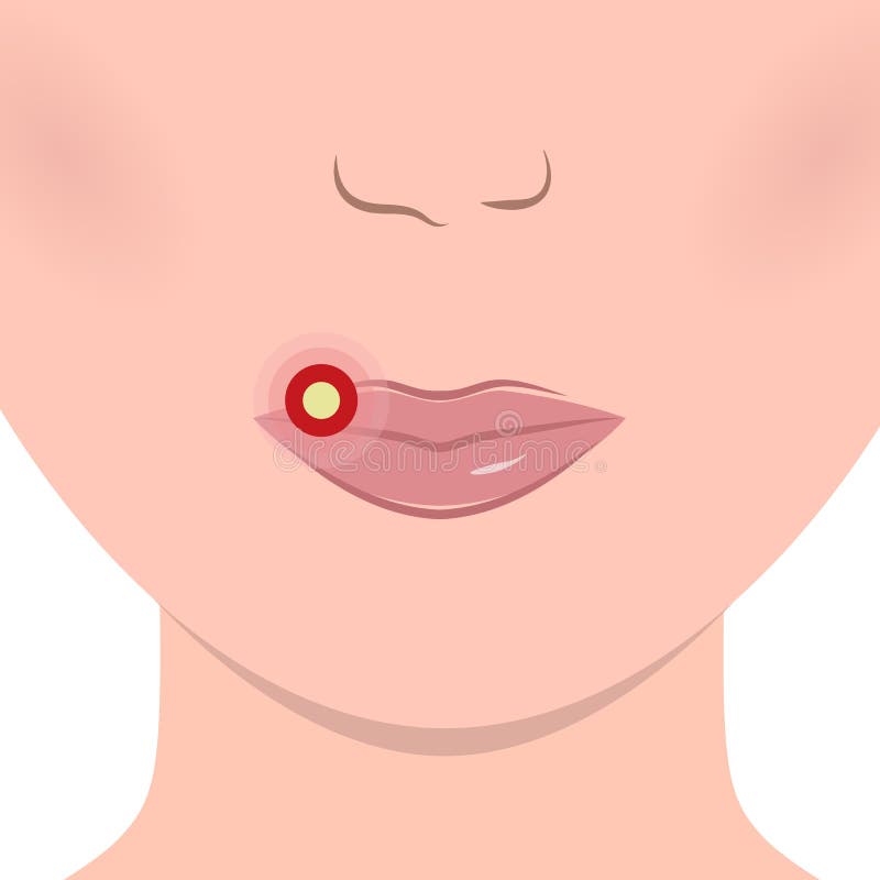 Herpes en dolor frío de los labios ilustración del vector Herpes en dolor frío de los labios ilustración del vector