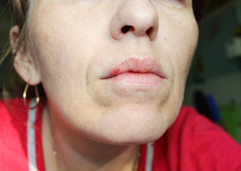 Herpes on the Lips of a Young Woman Stock Image Image of lips, macro