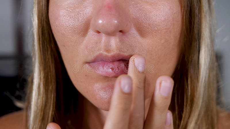 Herpes simplex virus infectie beïnvloedt vrouwenlip