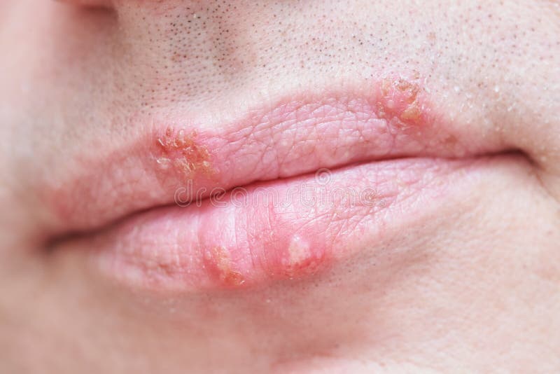 Herpes Simplex Virus Infection On Male Face Lips Stock Photo