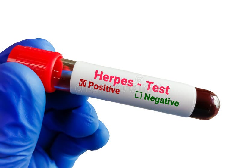 herpes-test-herpes-simplex-virus-hsv-stock-image-image-of-virus-illness-278111751