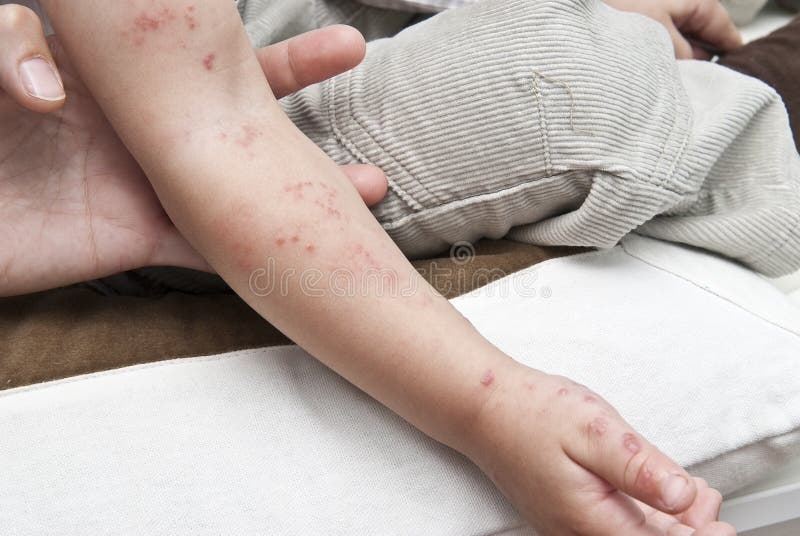 Herpes w dziecko ręce. obraz stock Herpes w dziecko ręce. obraz stock