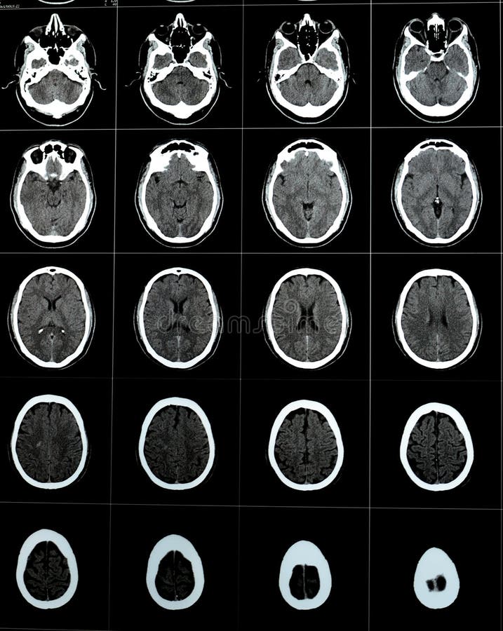 Brain CT scan showing brainstem cavernoma, right centrum semiovale developmental venous anomaly, intra cerebral haematoma, faint hypodense lesion in medulla oblongata and pontomedullary junction. Brain CT scan showing brainstem cavernoma, right centrum semiovale developmental venous anomaly, intra cerebral haematoma, faint hypodense lesion in medulla oblongata and pontomedullary junction