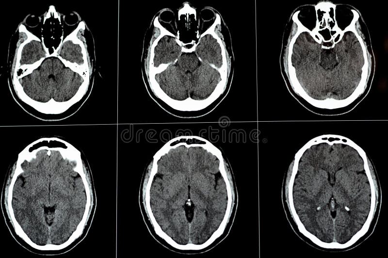 Brain CT scan showing brainstem cavernoma, right centrum semiovale developmental venous anomaly, intra cerebral haematoma, faint hypodense lesion in medulla oblongata and pontomedullary junction. Brain CT scan showing brainstem cavernoma, right centrum semiovale developmental venous anomaly, intra cerebral haematoma, faint hypodense lesion in medulla oblongata and pontomedullary junction