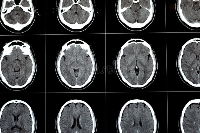 Brain CT scan showing brainstem cavernoma, right centrum semiovale developmental venous anomaly, intra cerebral haematoma, faint hypodense lesion in medulla oblongata and pontomedullary junction. Brain CT scan showing brainstem cavernoma, right centrum semiovale developmental venous anomaly, intra cerebral haematoma, faint hypodense lesion in medulla oblongata and pontomedullary junction